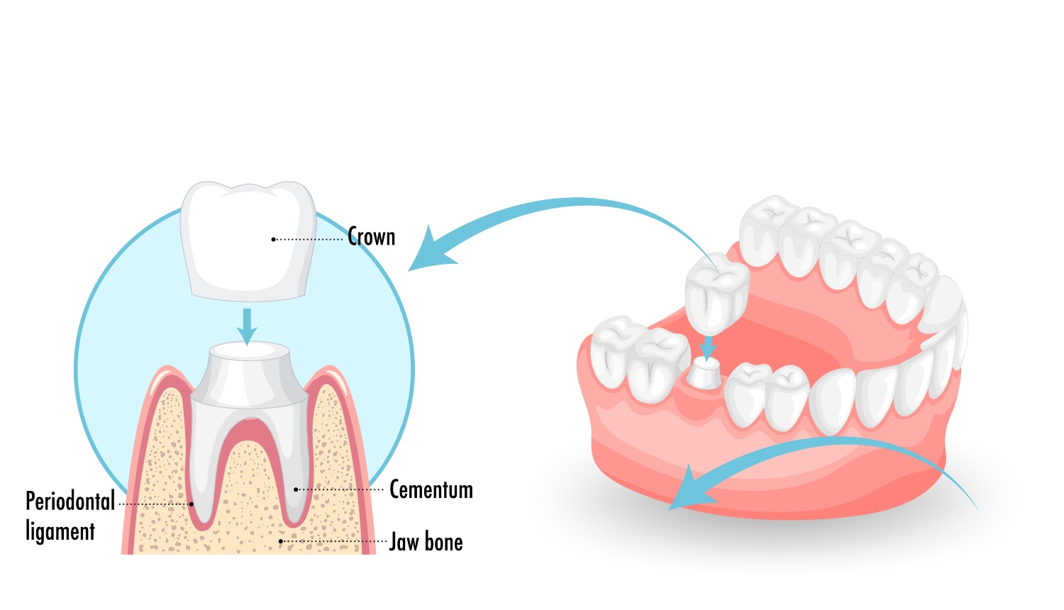 Dental Crowns in Burlington