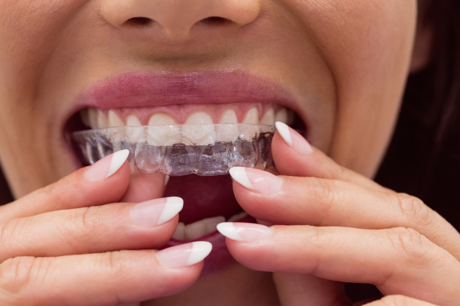 Invisalign in Burlington